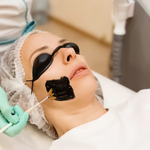 Carbon face peeling procedure in a beauty salon. Hardware cosmetology treatment.